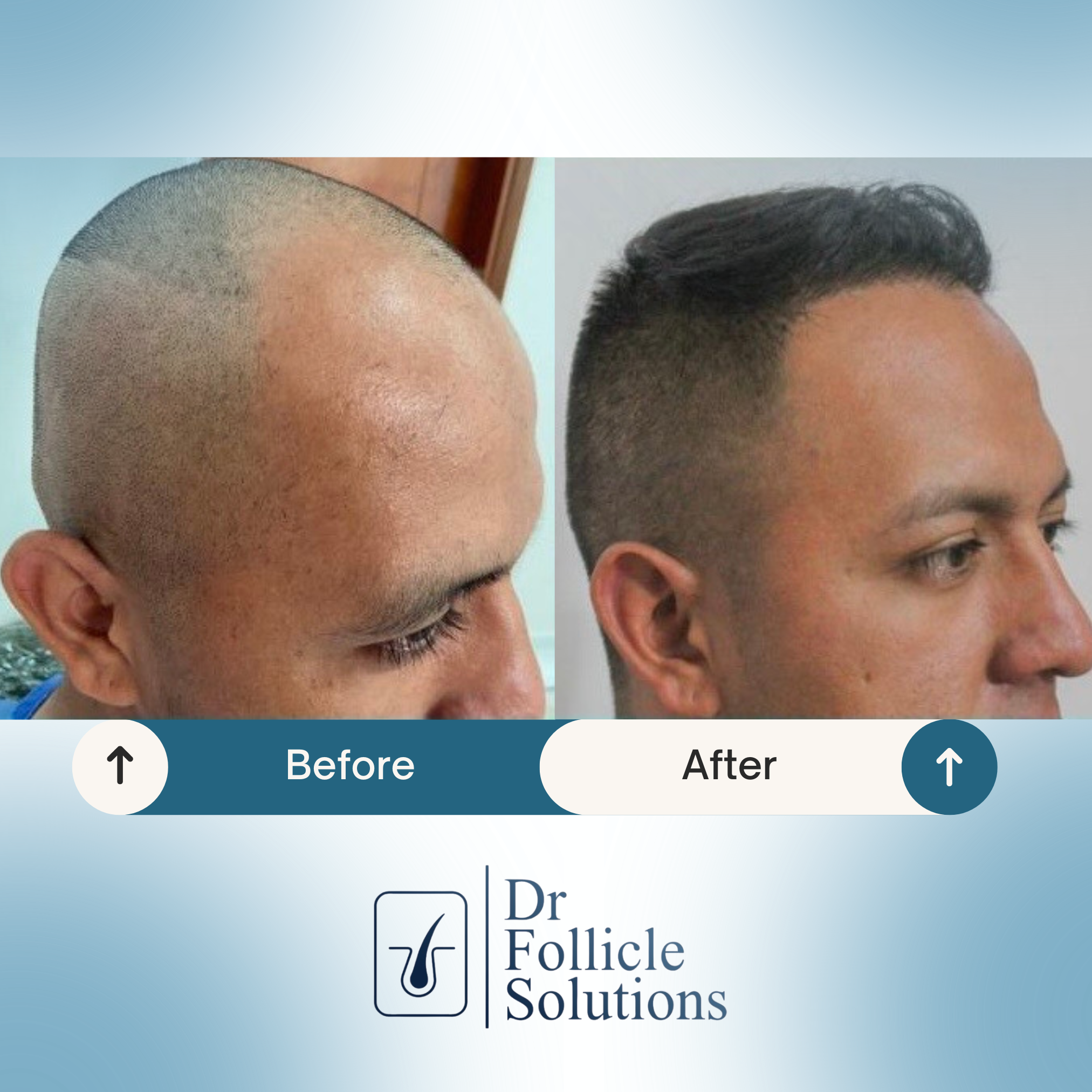 hair transplant clinic colombia