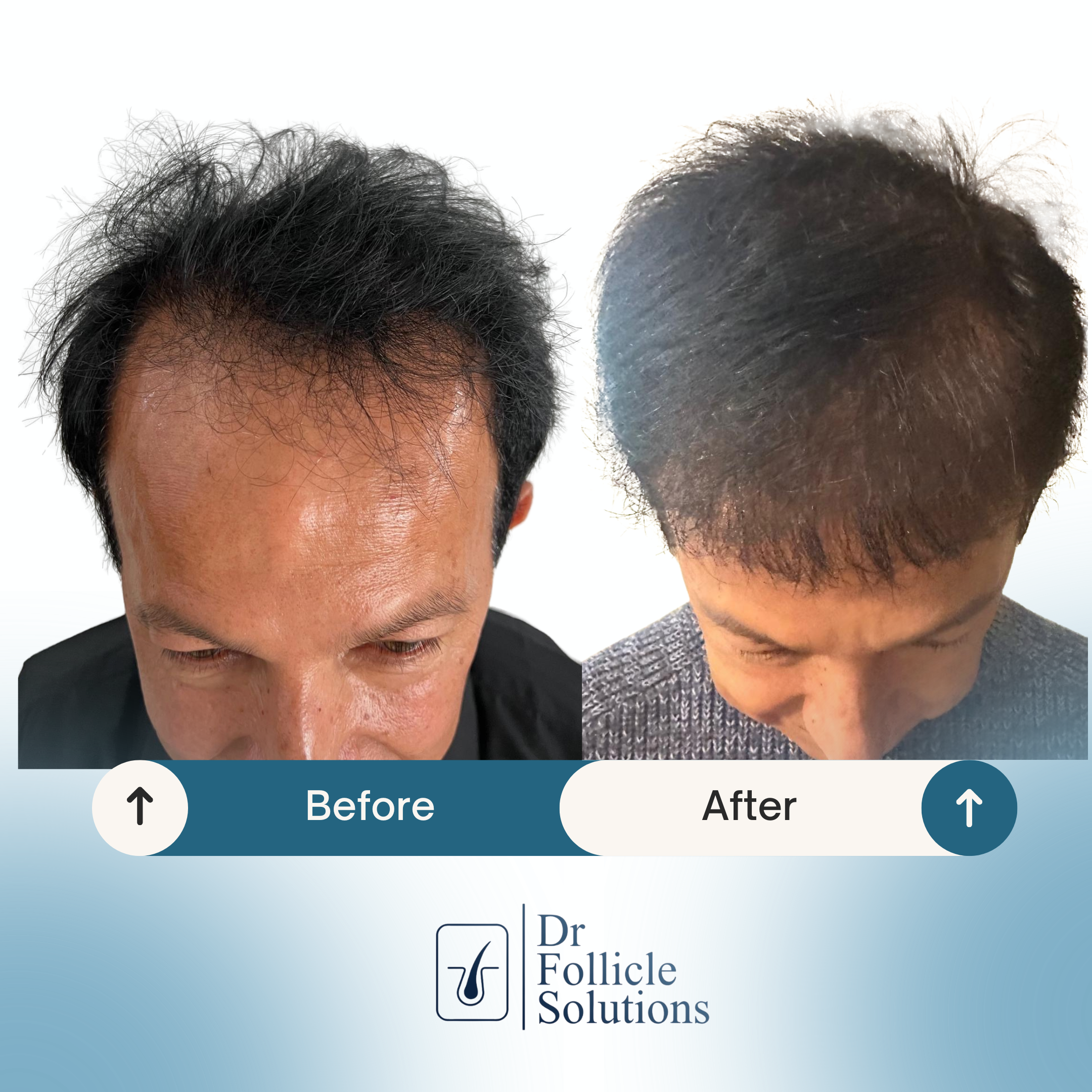best hair transplant clinic colombia