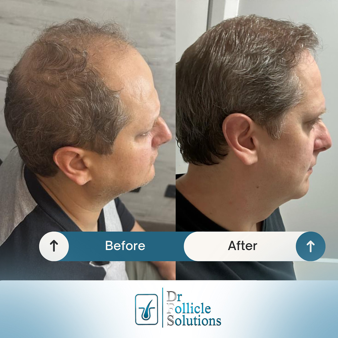 hair transplant clinic medellin